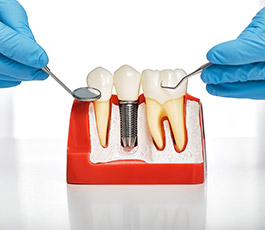 What Are the Different Types of Dental Implants