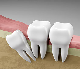 The most common myths and lies about wisdom teeth